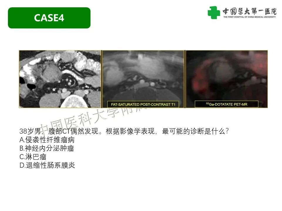 影像PPT - 【PPT】肠系膜病变的要点及鉴别诊断-27
