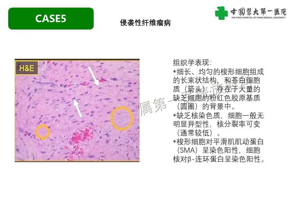 影像PPT - 【PPT】肠系膜病变的要点及鉴别诊断-31