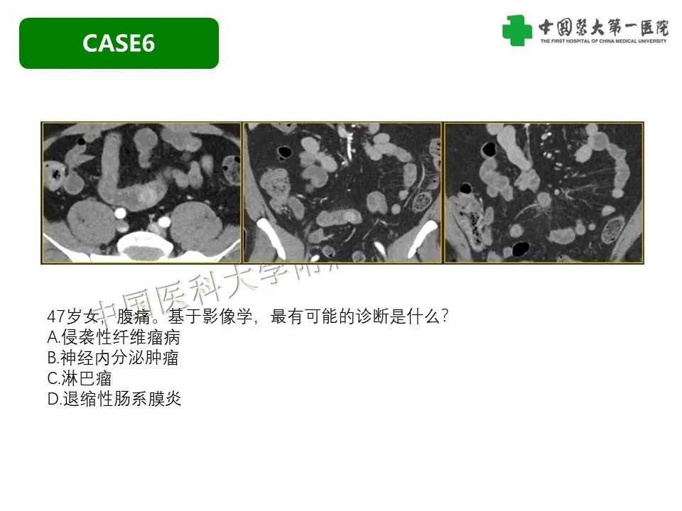 影像PPT - 【PPT】肠系膜病变的要点及鉴别诊断-33