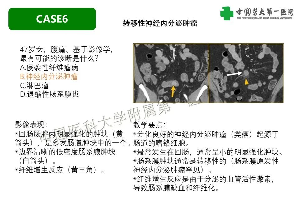影像PPT - 【PPT】肠系膜病变的要点及鉴别诊断-34
