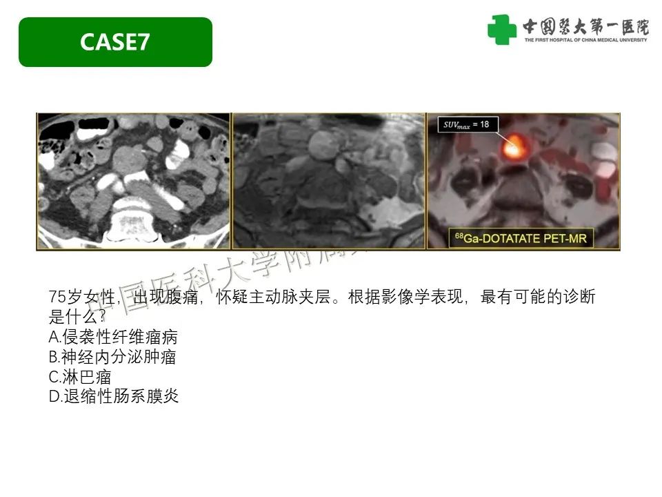 影像PPT - 【PPT】肠系膜病变的要点及鉴别诊断-35