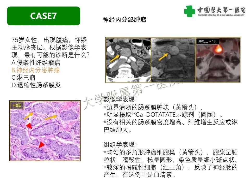 影像PPT - 【PPT】肠系膜病变的要点及鉴别诊断-36