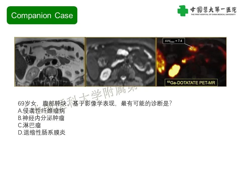 影像PPT - 【PPT】肠系膜病变的要点及鉴别诊断-38