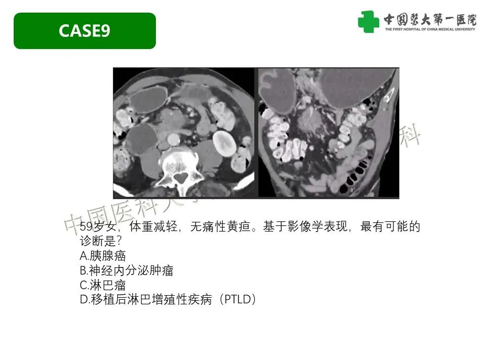 影像PPT - 【PPT】肠系膜病变的要点及鉴别诊断-42