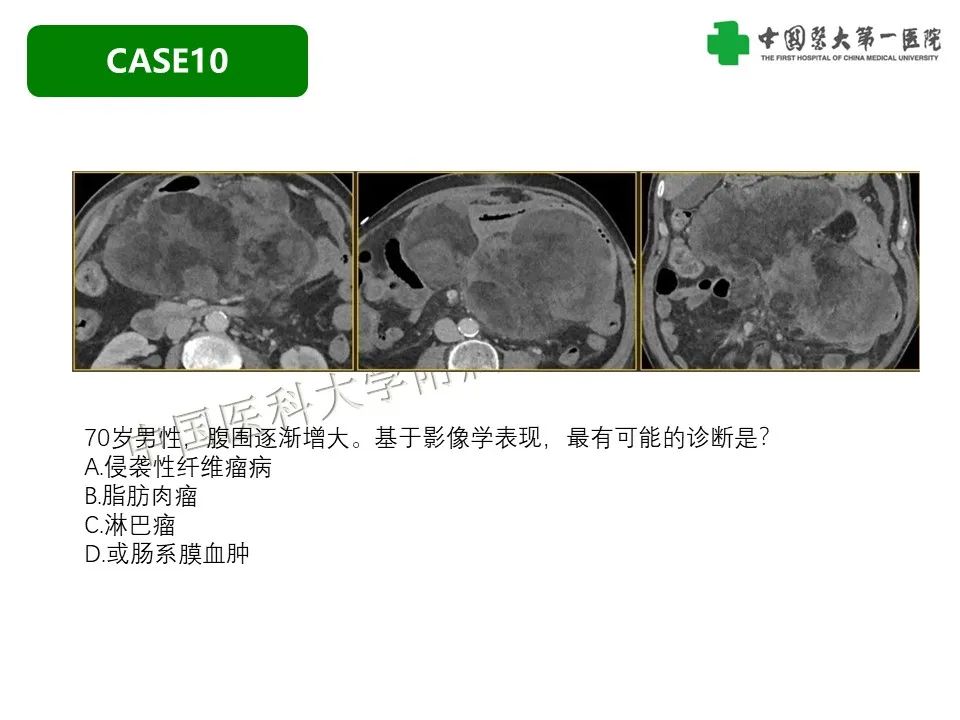 影像PPT - 【PPT】肠系膜病变的要点及鉴别诊断-45