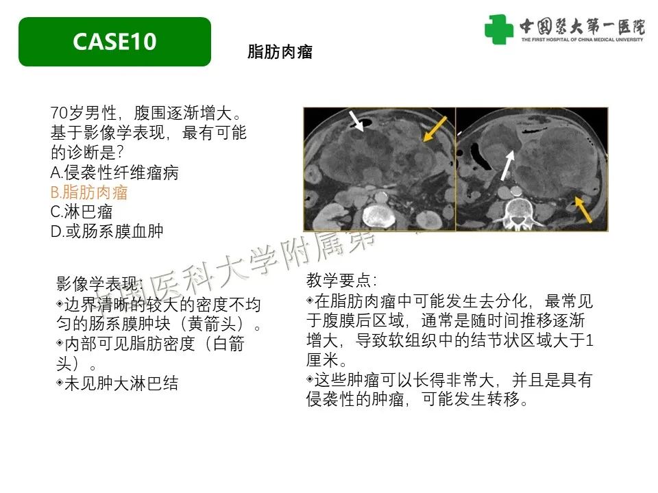 影像PPT - 【PPT】肠系膜病变的要点及鉴别诊断-46
