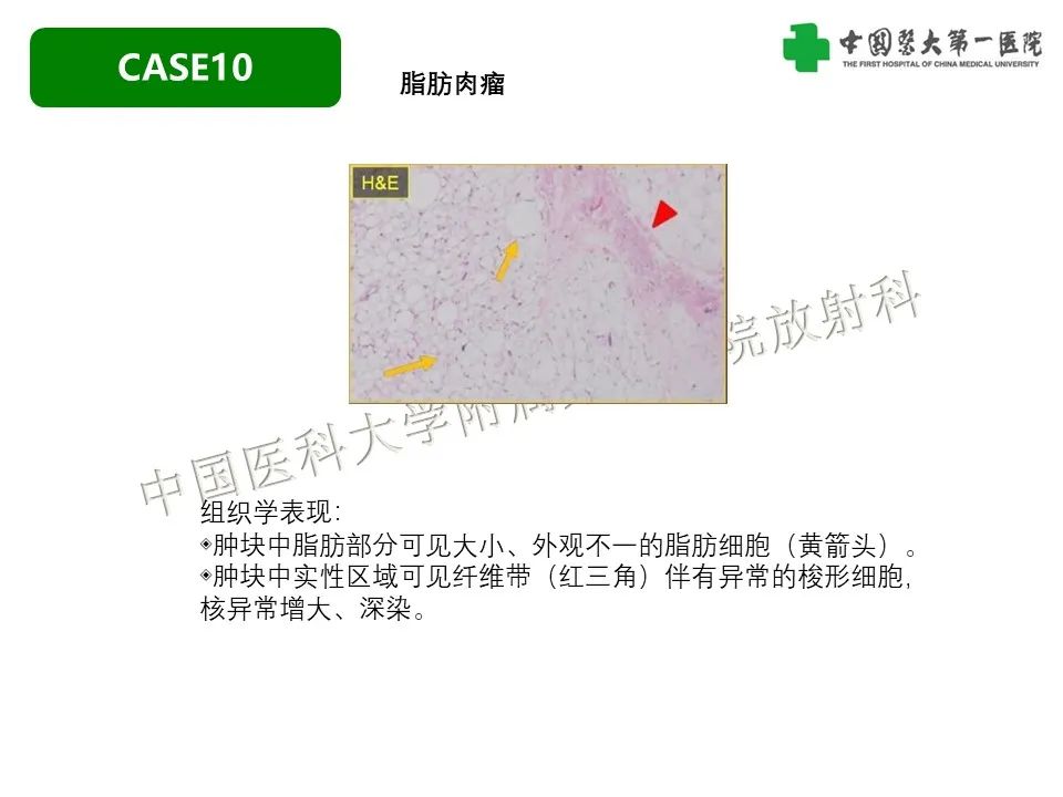 影像PPT - 【PPT】肠系膜病变的要点及鉴别诊断-47
