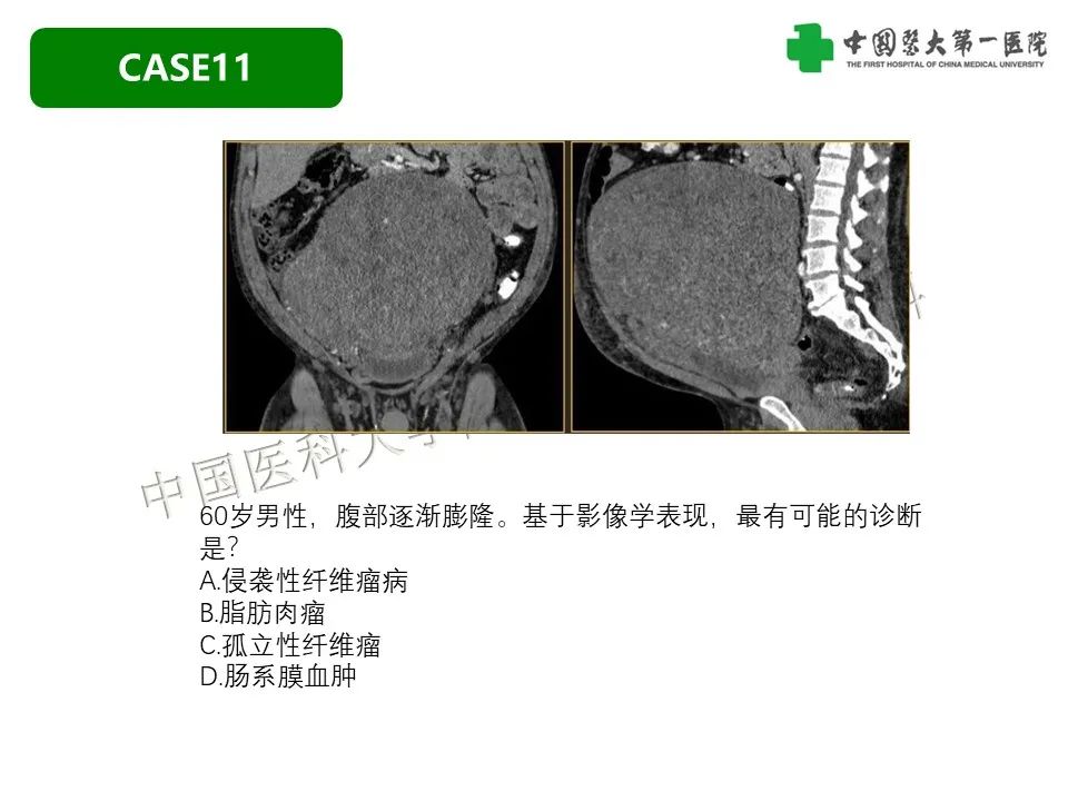 影像PPT - 【PPT】肠系膜病变的要点及鉴别诊断-48