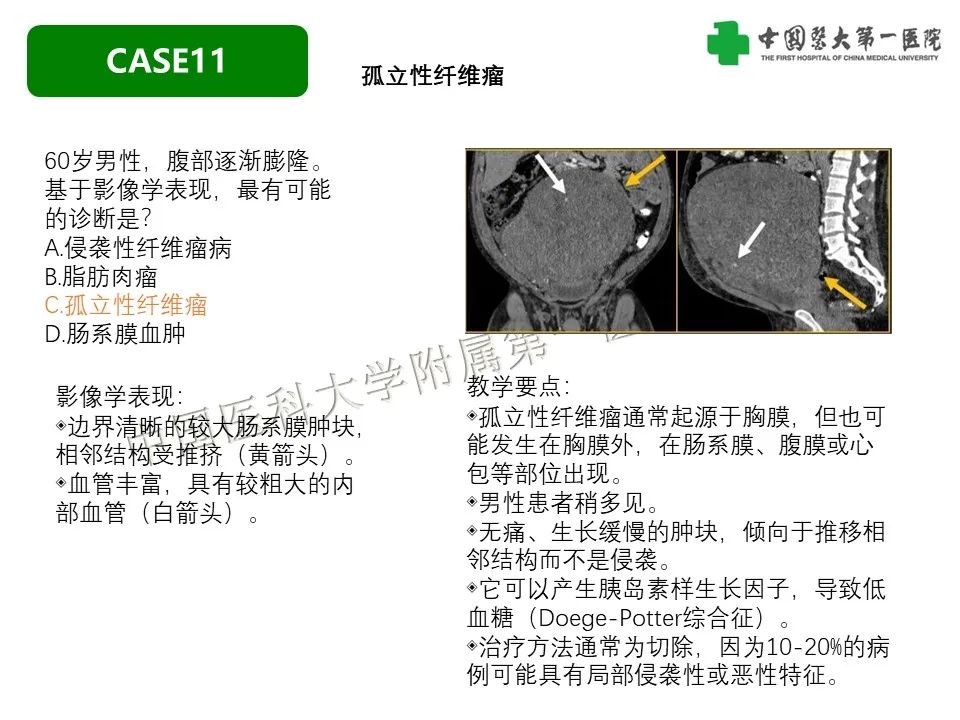 影像PPT - 【PPT】肠系膜病变的要点及鉴别诊断-49