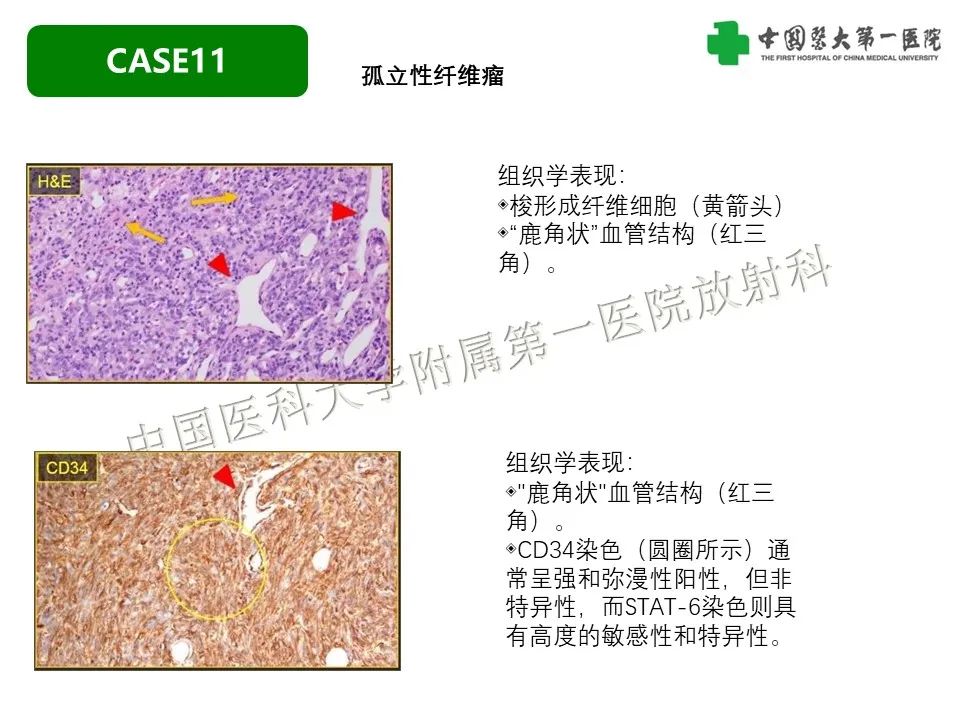 影像PPT - 【PPT】肠系膜病变的要点及鉴别诊断-50