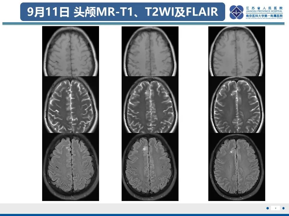 影像PPT - 【PPT】多结节及空泡样神经元肿瘤-3