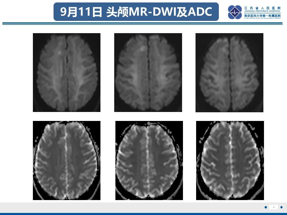 影像PPT - 【PPT】多结节及空泡样神经元肿瘤-4