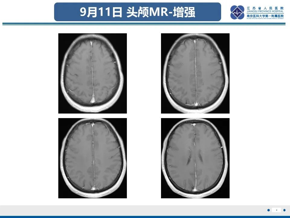 影像PPT - 【PPT】多结节及空泡样神经元肿瘤-5