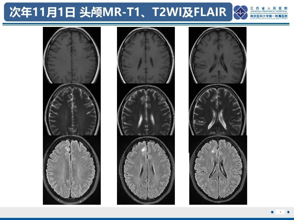 影像PPT - 【PPT】多结节及空泡样神经元肿瘤-7