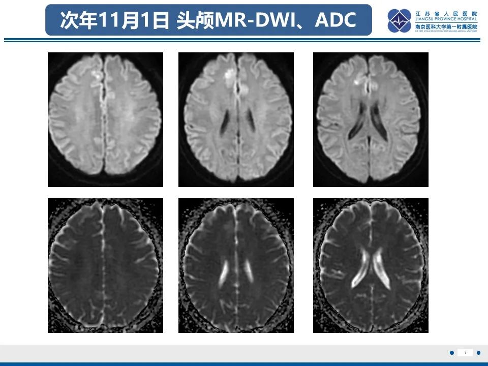 影像PPT - 【PPT】多结节及空泡样神经元肿瘤-8