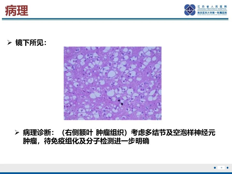 影像PPT - 【PPT】多结节及空泡样神经元肿瘤-16