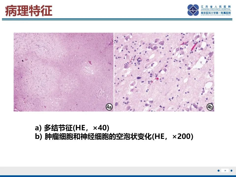 影像PPT - 【PPT】多结节及空泡样神经元肿瘤-21