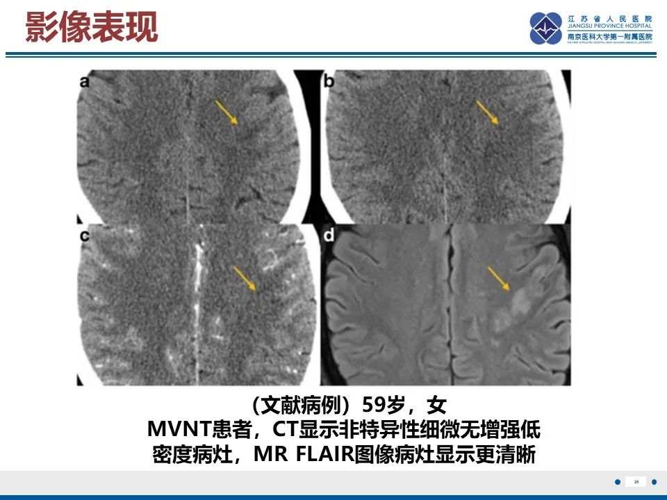 影像PPT - 【PPT】多结节及空泡样神经元肿瘤-26