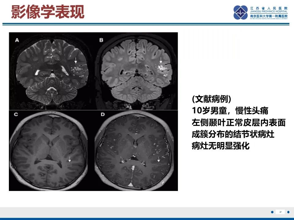 影像PPT - 【PPT】多结节及空泡样神经元肿瘤-28
