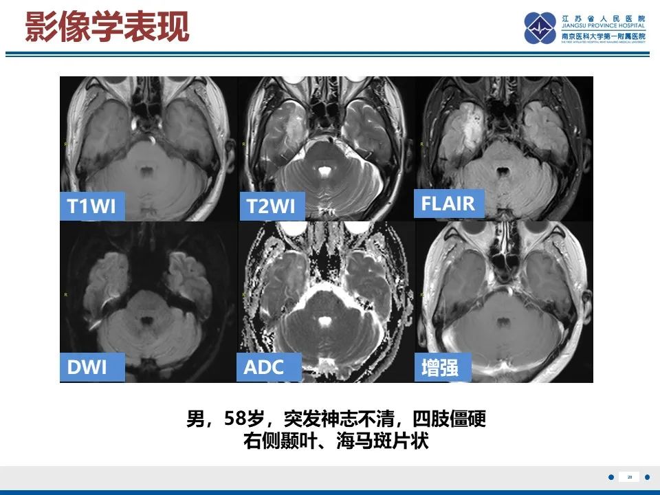 影像PPT - 【PPT】多结节及空泡样神经元肿瘤-29