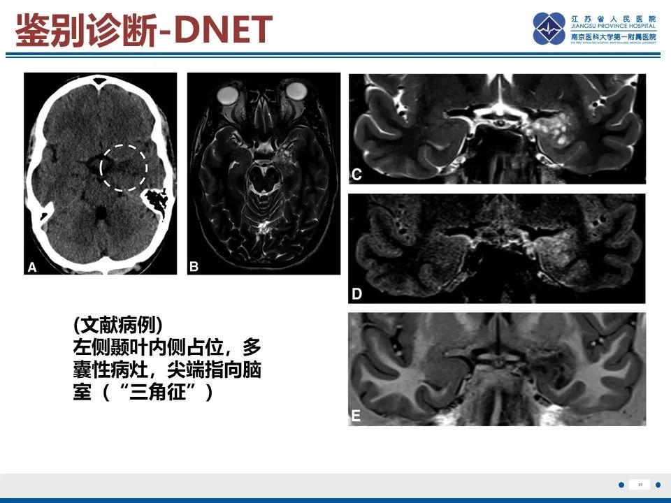 影像PPT - 【PPT】多结节及空泡样神经元肿瘤-32
