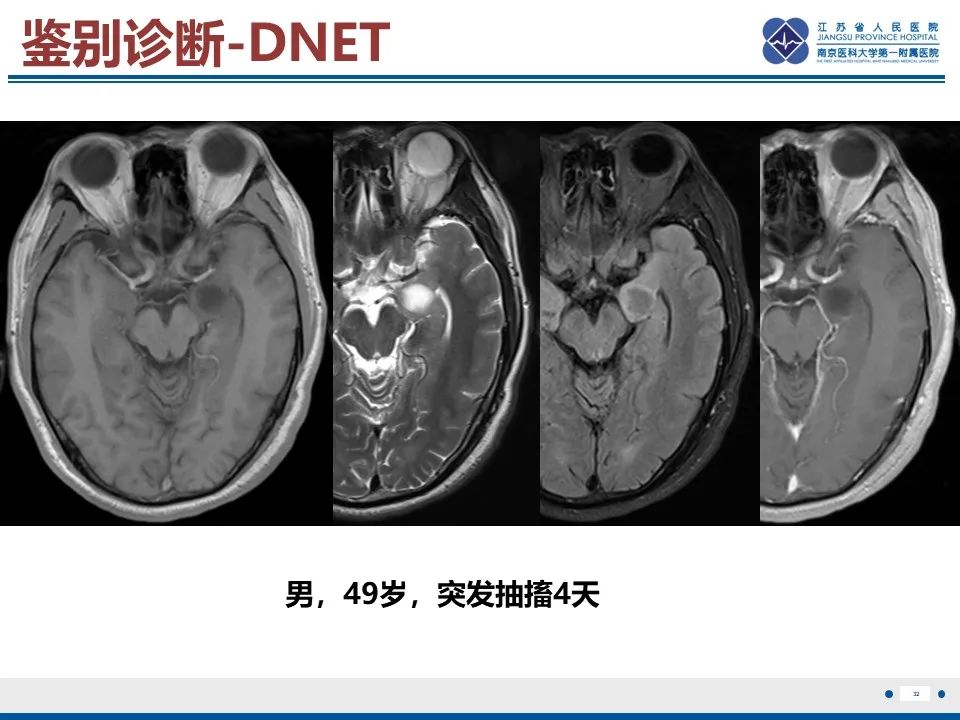 影像PPT - 【PPT】多结节及空泡样神经元肿瘤-33