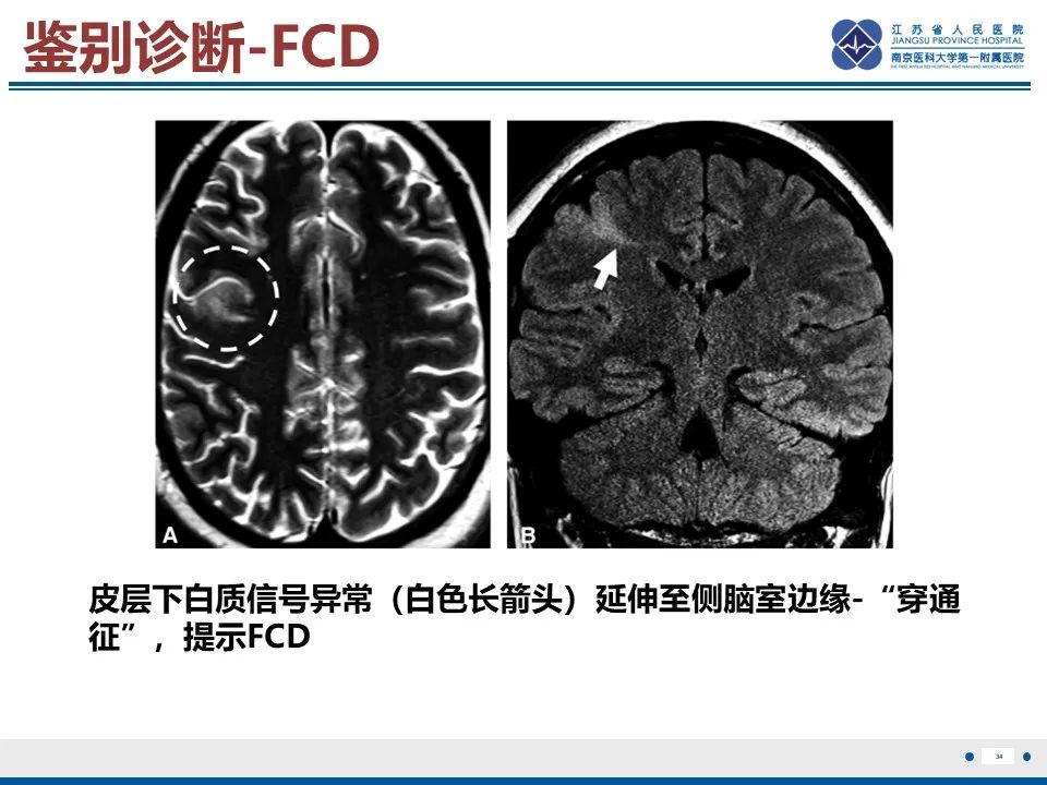 影像PPT - 【PPT】多结节及空泡样神经元肿瘤-35