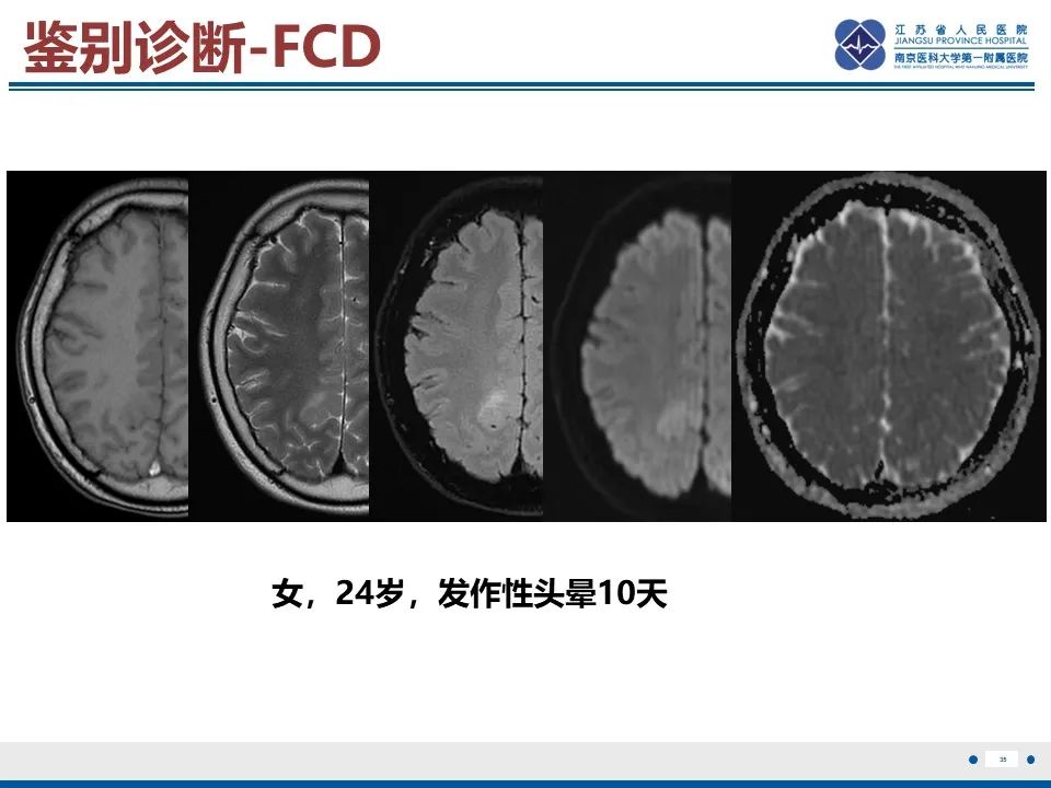 影像PPT - 【PPT】多结节及空泡样神经元肿瘤-36