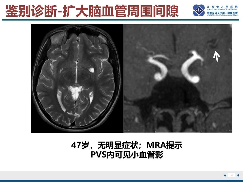 影像PPT - 【PPT】多结节及空泡样神经元肿瘤-38