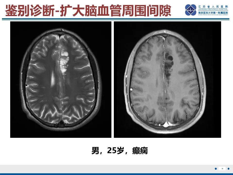 影像PPT - 【PPT】多结节及空泡样神经元肿瘤-39