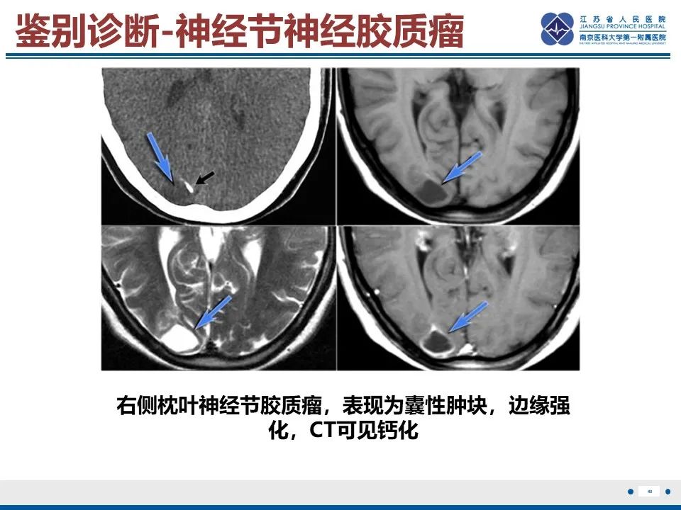 影像PPT - 【PPT】多结节及空泡样神经元肿瘤-41