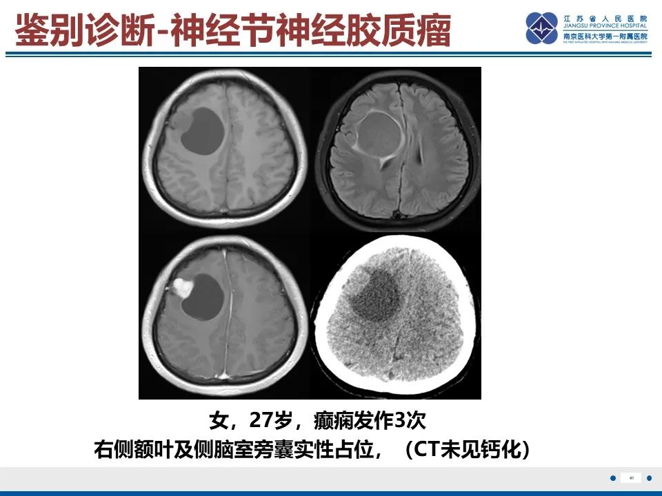 影像PPT - 【PPT】多结节及空泡样神经元肿瘤-42