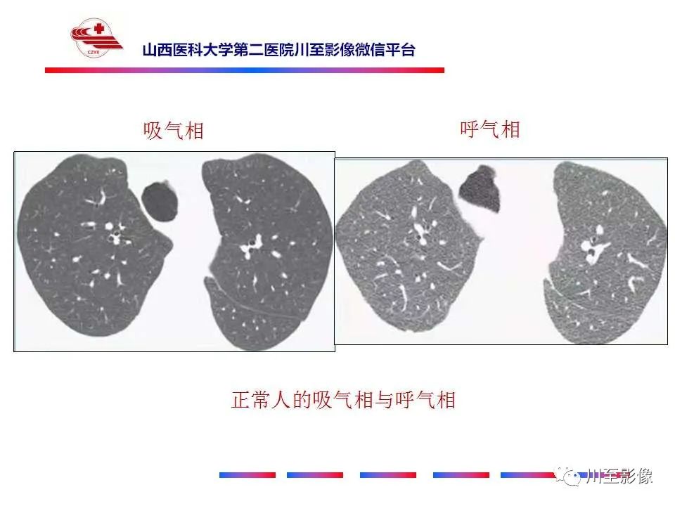 影像PPT - 马赛克征-1 影像PPT - 马赛克征-1