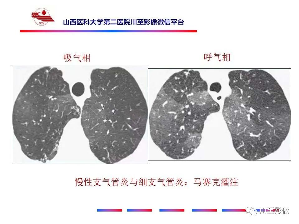影像PPT - 马赛克征-2 影像PPT - 马赛克征-2