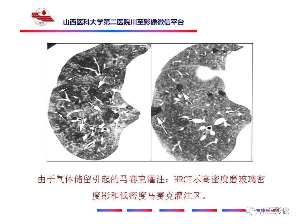 影像PPT - 马赛克征-3 影像PPT - 马赛克征-3