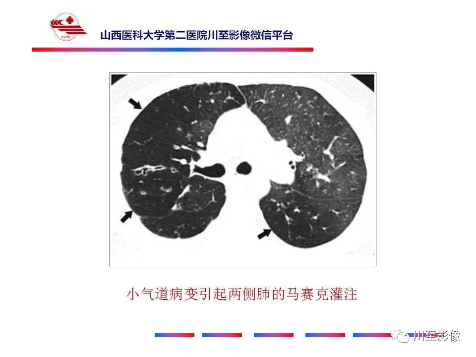 影像PPT - 马赛克征-4 影像PPT - 马赛克征-4