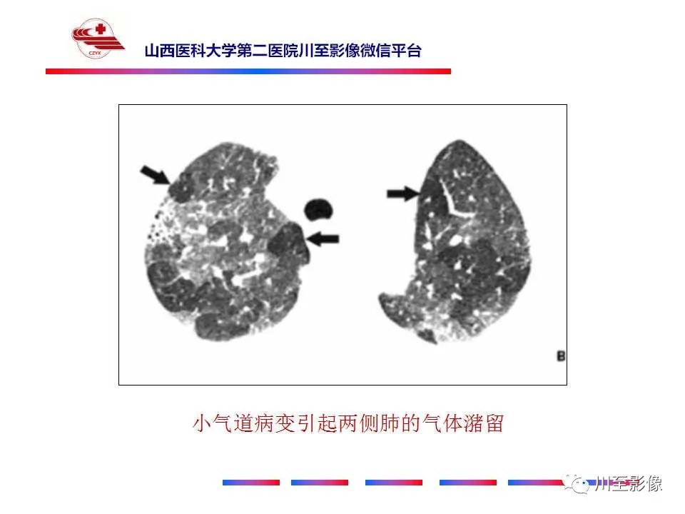 影像PPT - 马赛克征-5 影像PPT - 马赛克征-5