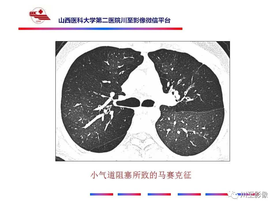 影像PPT - 马赛克征-6 影像PPT - 马赛克征-6