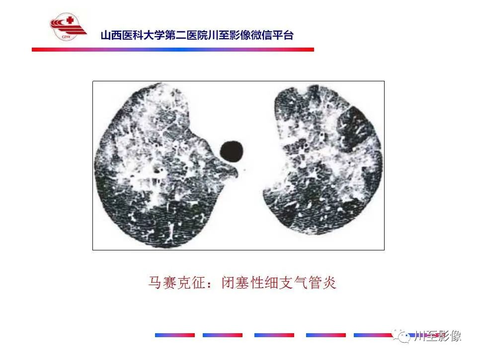 影像PPT - 马赛克征-7 影像PPT - 马赛克征-7