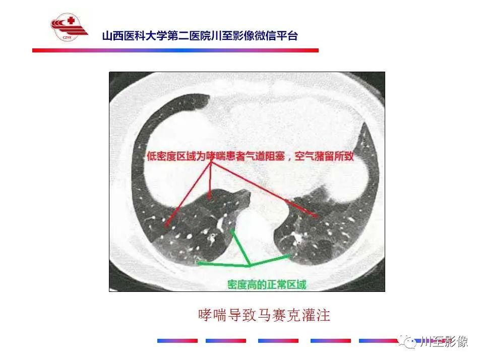 影像PPT - 马赛克征-8 影像PPT - 马赛克征-8