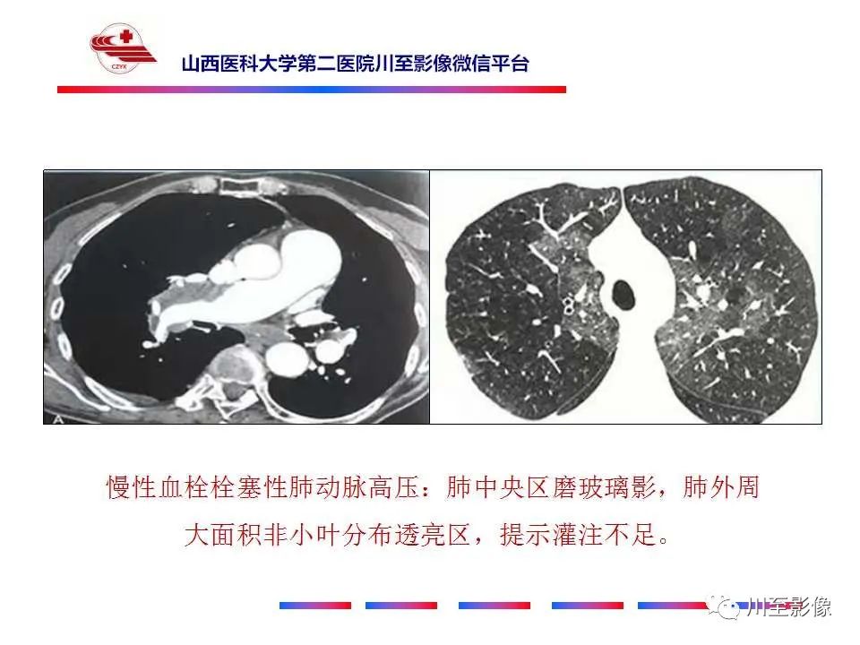 影像PPT - 马赛克征-9 影像PPT - 马赛克征-9
