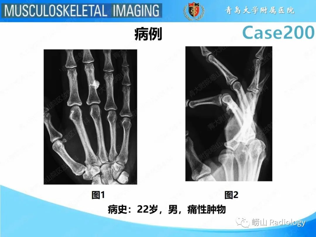 影像PPT - 【PPT】Nora病-2
