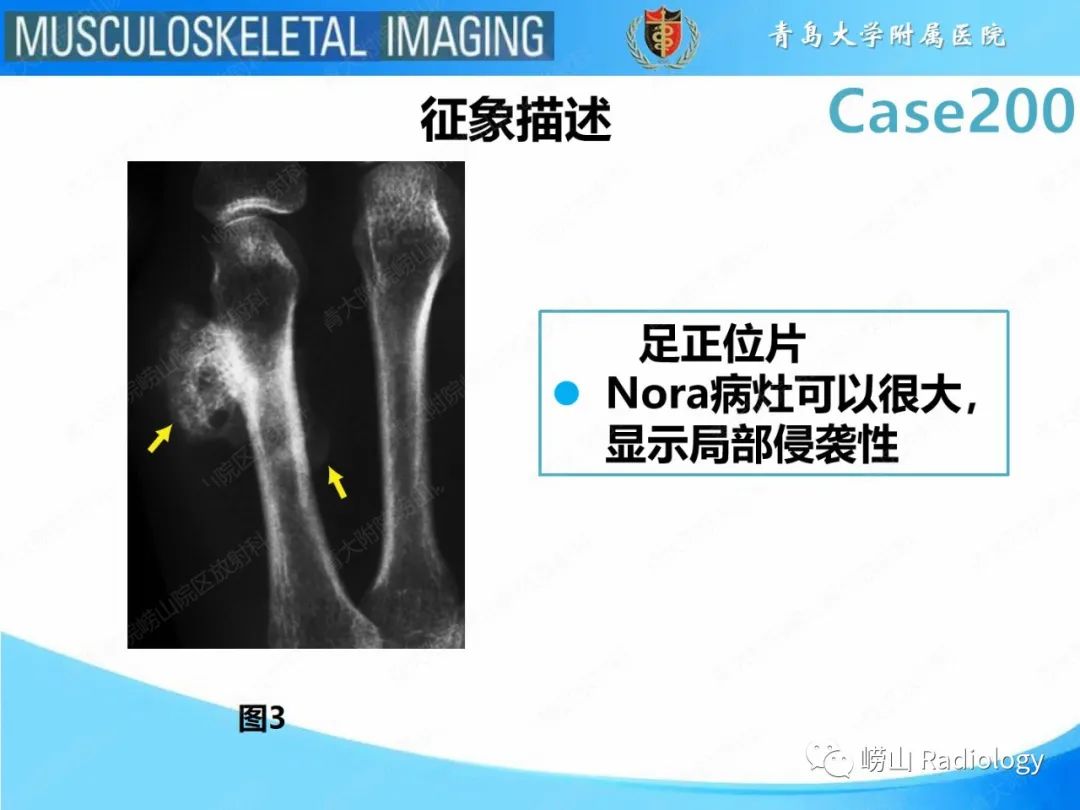 影像PPT - 【PPT】Nora病-13