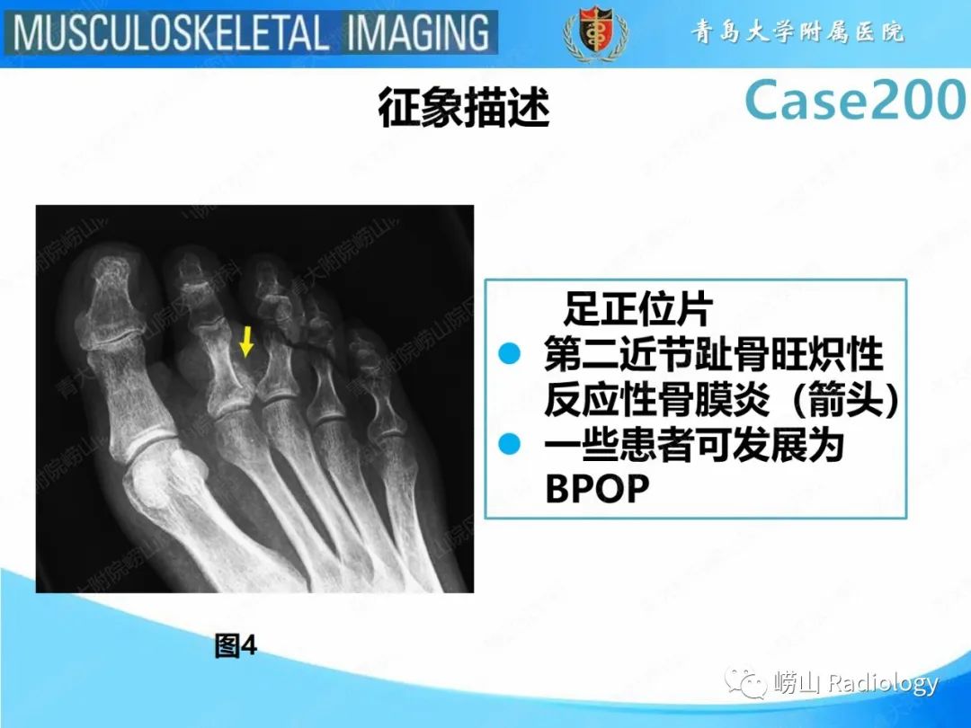影像PPT - 【PPT】Nora病-14