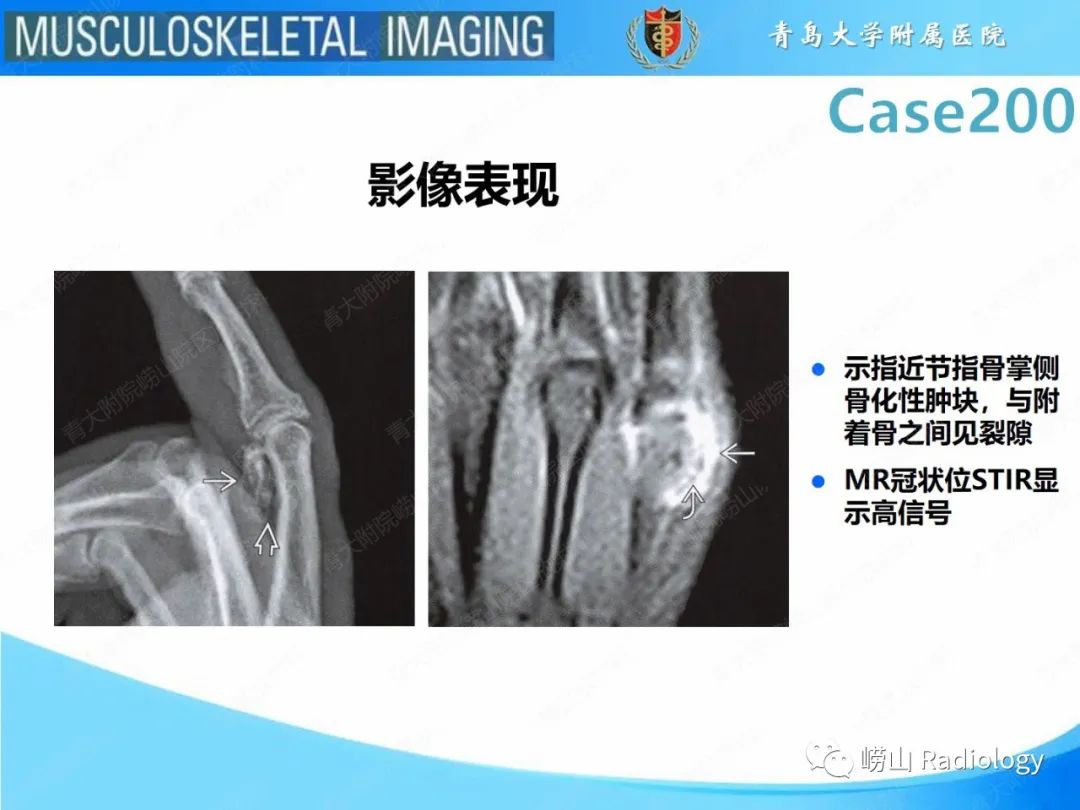 影像PPT - 【PPT】Nora病-20
