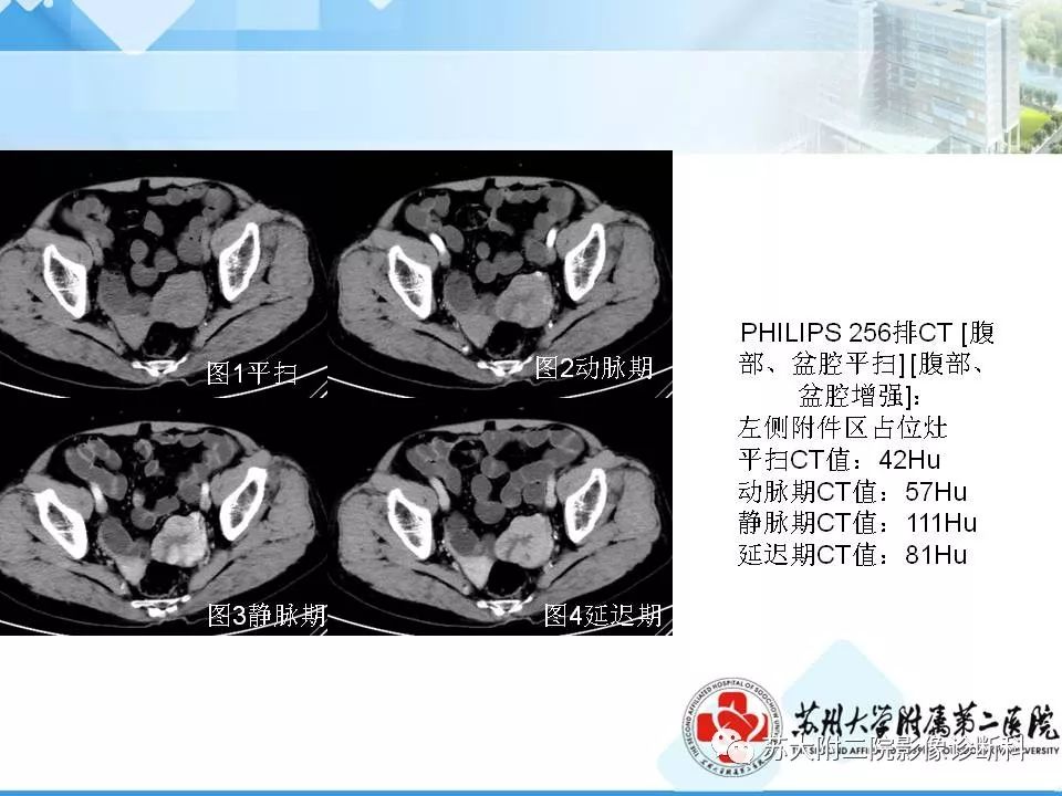 影像PPT - 【病例】卵巢浆液性腺癌 VS 浆液性囊腺瘤-5