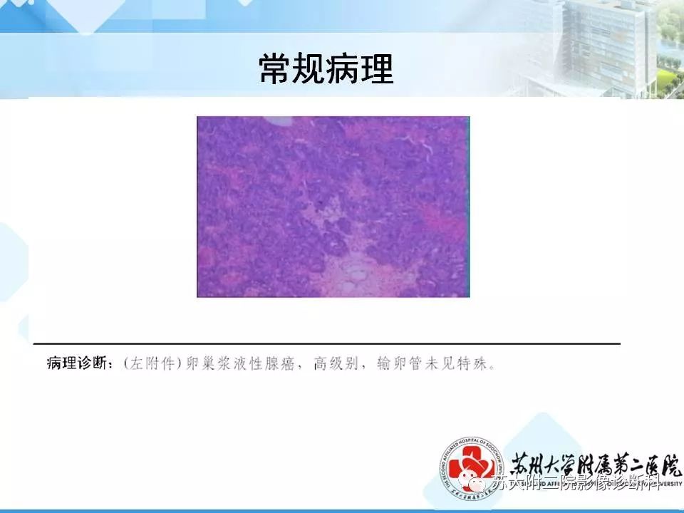 影像PPT - 【病例】卵巢浆液性腺癌 VS 浆液性囊腺瘤-7