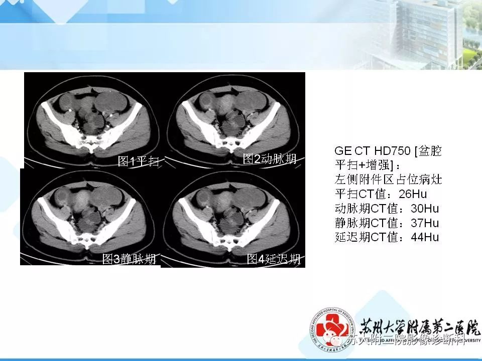 影像PPT - 【病例】卵巢浆液性腺癌 VS 浆液性囊腺瘤-18