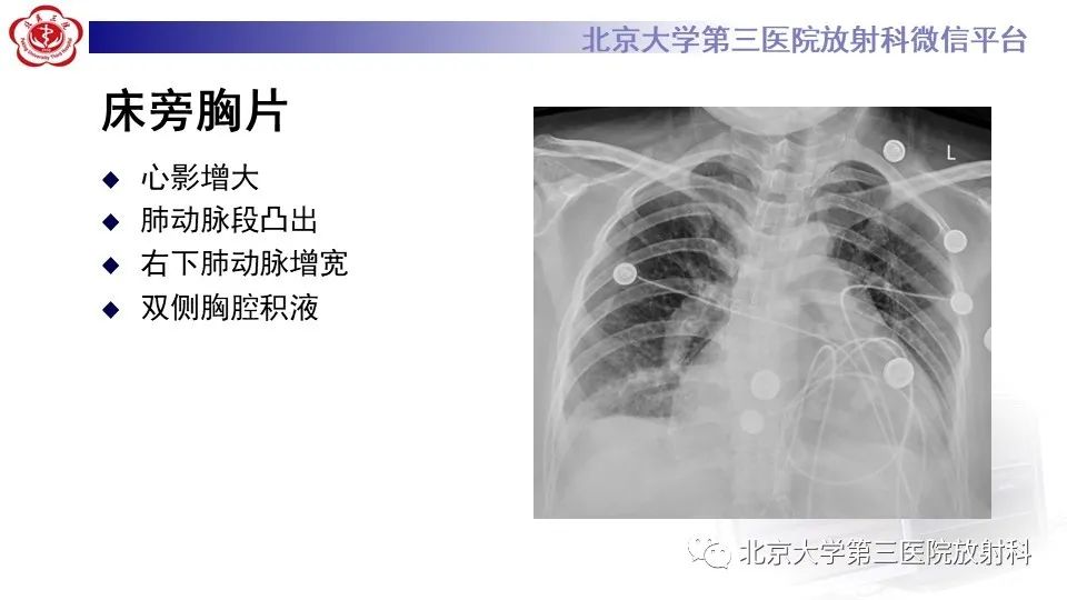 影像PPT - 【PPT】肺动脉高压的影像评估-3