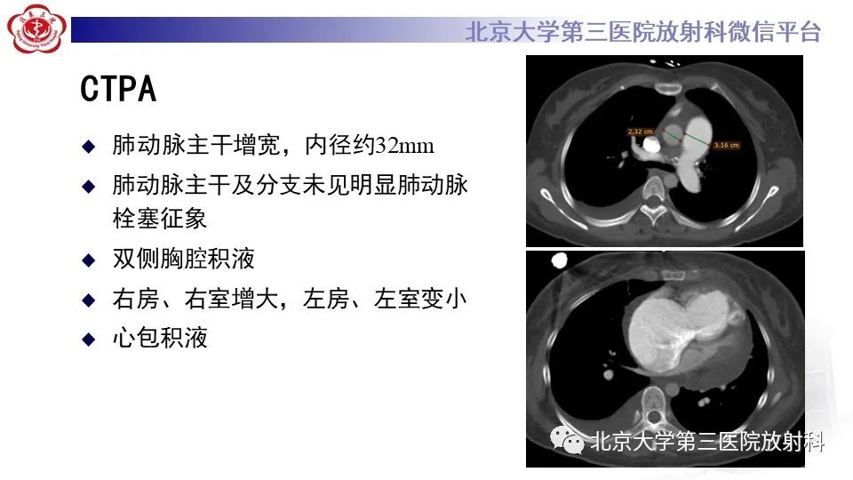 影像PPT - 【PPT】肺动脉高压的影像评估-4